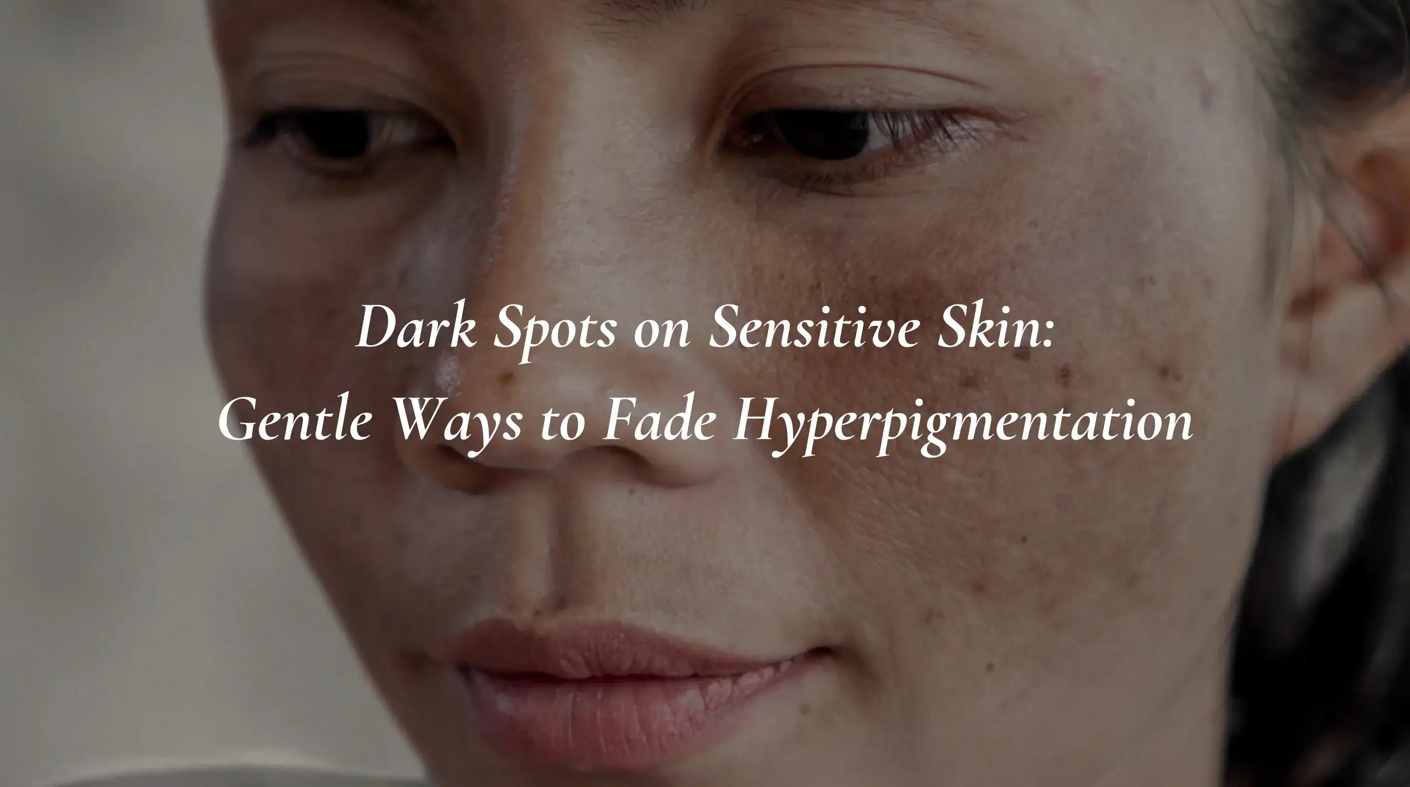 Dark Spots on Sensitive Skin: Gentle Ways to Fade Hyperpigmentation