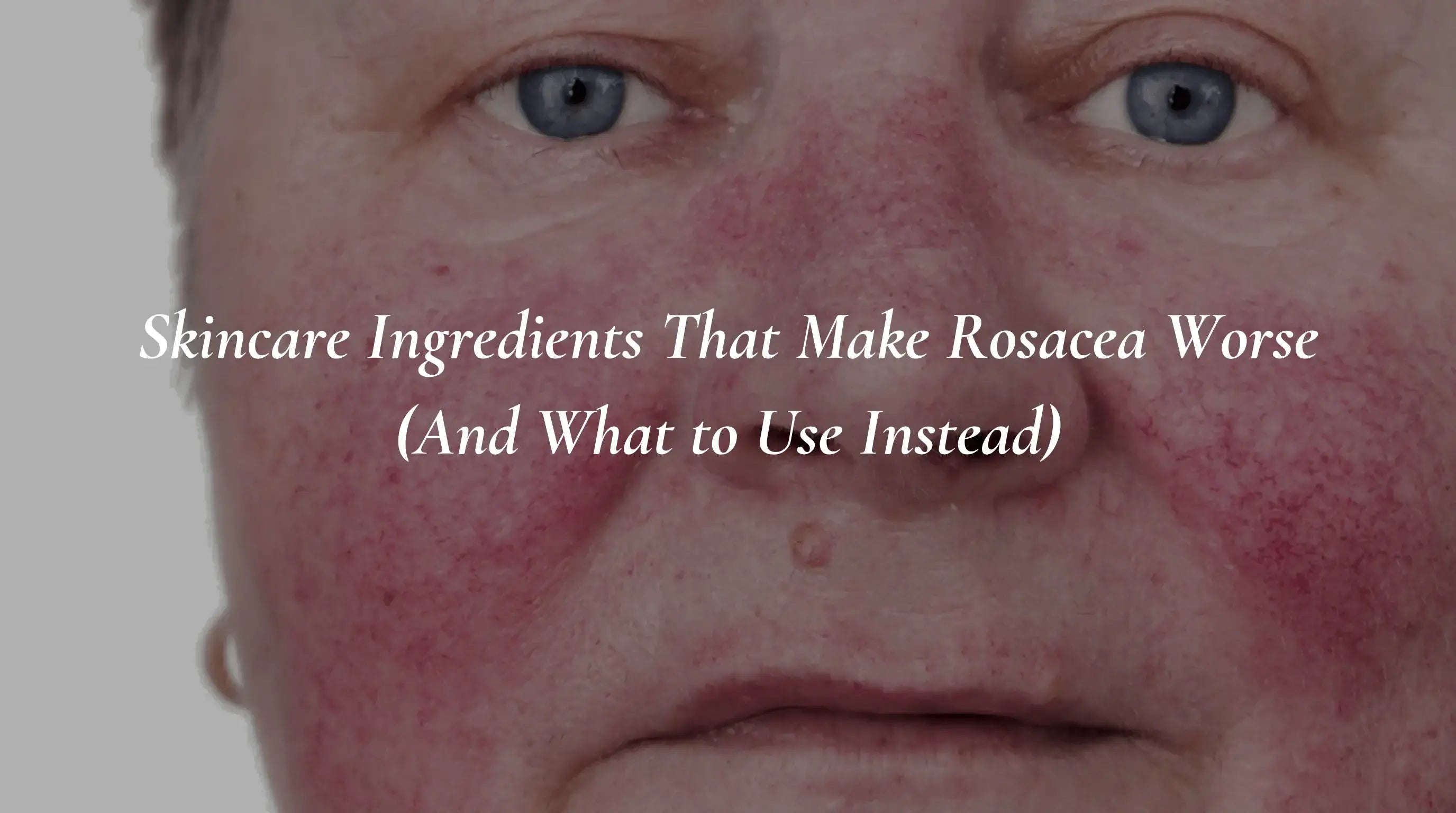 Skincare Ingredients That Make Rosacea Worse (And What to Use Instead)